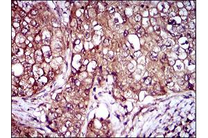Immunohistochemical analysis of paraffin-embedded lung cancer tissues using IL3RA mouse mAb with DAB staining.