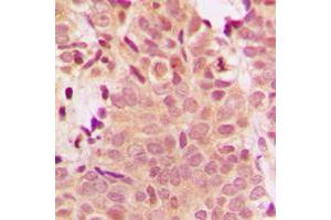 Immunohistochemical analysis of Histone Deacetylase 5 staining in human breast cancer formalin fixed paraffin embedded tissue section. (HDAC5 anticorps  (Center))