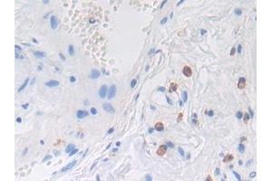 Detection of LRP1 in Human Stomach cancer Tissue using Polyclonal Antibody to Low Density Lipoprotein Receptor Related Protein 1 (LRP1) (LRP1 anticorps  (AA 4441-4544))
