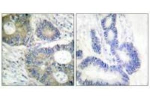 Immunohistochemical analysis of paraffin-embedded human colon carcinoma tissue using 4E-BP1 (Ab-64) antibody. (eIF4EBP1 anticorps  (Ser65))