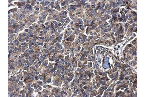 IHC-P Image LYRIC antibody [N2C3] detects LYRIC protein at cytosol on human breast carcinoma by immunohistochemical analysis.