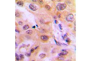 Immunohistochemical analysis of Cytochrome P450 2J2 staining in human liver cancer formalin fixed paraffin embedded tissue section.