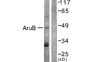 Immunohistochemistry analysis of paraffin-embedded human liver carcinoma tissue using AurB (Ab-12) antibody. (Aurora Kinase B anticorps)