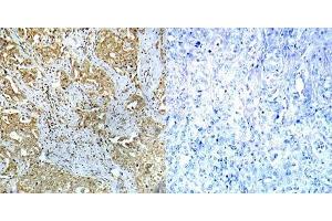 Immunohistochemical analysis of paraffin-embedded human breast carcinoma tissue using Abl1 (phospho- Tyr412) antibody (E012002). (ABL1 anticorps  (pTyr412))