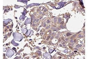ABIN6267428 at 1/100 staining human breast carcinoma tissue sections by IHC-P. (NFKB1 anticorps  (pSer927))