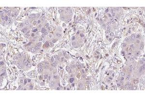 ABIN6273951 at 1/100 staining Human liver cancer tissue by IHC-P. (NMUR2 anticorps  (C-Term))
