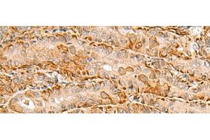 Immunohistochemistry of paraffin-embedded Human thyroid cancer tissue using C3orf38 Polyclonal Antibody at dilution of 1:80(x200) (C3orf38 anticorps)