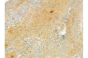 ABIN6264444 and ABIN6277722 at 1/100 staining human cervical carcinoma by IHC-P.
