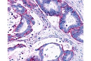 Anti-LPAR3 / LPA3 / EDG7 antibody IHC of human Colon, Carcinoma. (LPAR3 anticorps  (Cytoplasmic Domain))