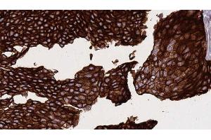 ABIN6268883 at 1/100 staining Human urothelial cancer tissue by IHC-P. (CD40 anticorps  (C-Term))