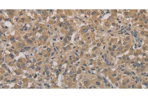 Immunohistochemistry of paraffin-embedded Human thyroid cancer tissue using AGTRAP Polyclonal Antibody at dilution 1:40 (AGTRAP anticorps)