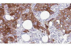 ABIN6272640 at 1/100 staining Human Head and neck cancer tissue by IHC-P. (COLEC12 anticorps  (C-Term))