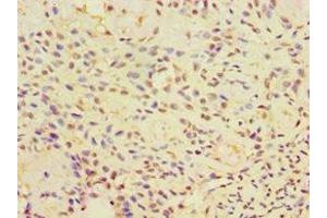 Immunohistochemistry of paraffin-embedded human breast cancer using ABIN7146575 at dilution of 1:100