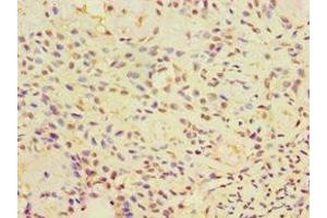 Immunohistochemistry of paraffin-embedded human breast cancer using ABIN7146575 at dilution of 1:100 (Calreticulin 3 anticorps  (AA 135-384))