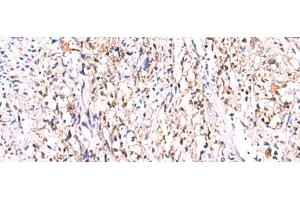 Immunohistochemistry of paraffin-embedded Human cervical cancer tissue using GMDS Polyclonal Antibody at dilution of 1:70(x200) (GMDS anticorps)