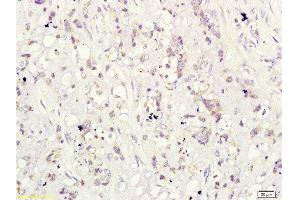 Formalin-fixed and paraffin-embedded human cervical carcinoma labeled with Rabbit Anti-CD160/By55 Polyclonal Antibody ( , Unconjugated at 1:200 followed by conjugation to the secondary antibody and DAB staining (CD160 anticorps  (AA 81-159))