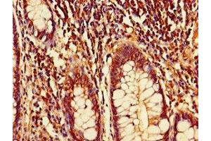 Immunohistochemistry of paraffin-embedded human colon cancer using ABIN7149691 at dilution of 1:100 (CDT2/RAMP anticorps  (AA 393-550))