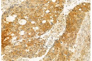 ABIN6259835 and ABIN6272935 at 1/100 staining Human lung cancer by IHC-P.