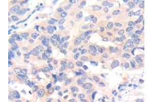 DAB staining on IHC-P; Samples: Human Breast cancer Tissue (IL-7 anticorps  (AA 26-177))
