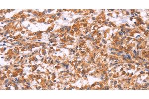 Immunohistochemistry of paraffin-embedded Human thyroid cancer tissue using EMP2 Polyclonal Antibody at dilution 1:30 (EMP2 anticorps)