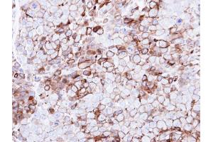IHC-P Image Immunohistochemical analysis of paraffin-embedded CL1-0 xenograft, using GPR86, antibody at 1:500 dilution. (Purinergic Receptor P2Y, G-Protein Coupled, 13 (P2RY13) (Internal Region) anticorps)