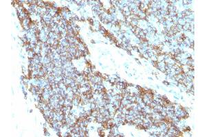 Formalin-fixed, paraffin-embedded human Ewing's sarcoma stained with CD99 Monoclonal Antibody (12E7+MIC2/877). (CD99 anticorps)