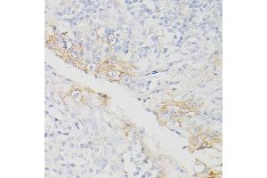Immunohistochemistry of paraffin-embedded Human chronic tonsillitis using PD-L1/CD274/CD274 Rabbit mAb (ABIN7266181) at dilution of 1:200 (40x lens). (PD-L1 anticorps  (Extracellular Domain))