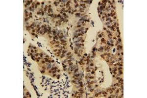 Immunohistochemical staining of human rectal cancer tissue with TNFAIP1 polyclonal antibody . (TNFAIP1 anticorps  (N-Term))