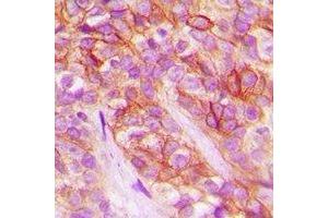 Immunohistochemical analysis of AT1 staining in human breast cancer formalin fixed paraffin embedded tissue section. (AGTR1a anticorps)
