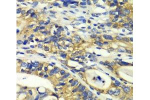 Immunohistochemistry of paraffin-embedded Human colon carcinoma using RPH3A Polyclonal Antibody at dilution of 1:100 (40x lens). (RPH3A anticorps)