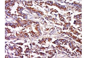Formalin-fixed and paraffin embedded human lung carcinoma labeled with Anti-FAIM3 Polyclonal Antibody, Unconjugated  at 1:500 followed by conjugation to the secondary antibody and DAB staining. (FAIM3 anticorps  (AA 51-150))