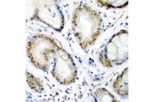 Immunohistochemistry of paraffin-embedded human colon carcinoma using SS18 antibody at dilution of 1:200 (40x lens). (SS18 anticorps)