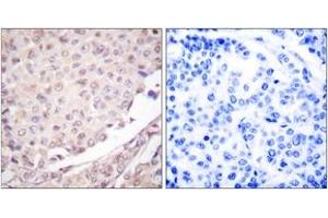 Immunohistochemistry analysis of paraffin-embedded human lung carcinoma tissue, using Cullin 1 Antibody. (Cullin 1 anticorps  (AA 727-776))