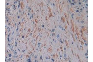 IHC-P analysis of Human Prostate cancer Tissue, with DAB staining. (FTL anticorps  (AA 2-175))