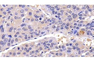 Detection of CASP8 in Human Liver cancer Tissue using Polyclonal Antibody to Caspase 8 (CASP8)
