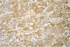 Immunohistochemistry was performed on paraffin-embedded human hepatocarcinoma using TRIM7 antibody (ABIN7800643), 1:200).