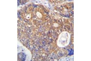 Immunohistochemistry analysis in formalin fixed and paraffin embedded human colon carcinoma reacted with PAICS Antibody (N-term) followed which was peroxidase conjugated to the secondary antibody and followed by DAB staining. (PAICS anticorps  (N-Term))
