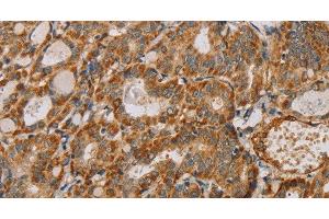 Immunohistochemistry of paraffin-embedded Human thyroid cancer using MTFR1 Polyclonal Antibody at dilution of 1:40 (MTFR1 anticorps)