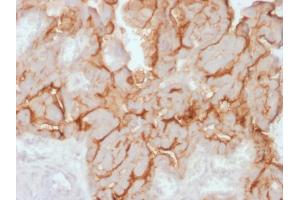 Formalin-fixed, paraffin-embedded human Ovarian Carcinoma stained with MUC16 Rabbit Recombinant Monoclonal Antibody (OCA125/2349R). (Recombinant MUC16 anticorps)