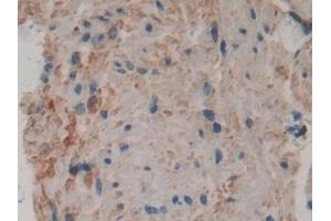 Detection of PLA2G4 in Human Stomach cancer Tissue using Polyclonal Antibody to Cytosolic Phospholipase A2 (PLA2G4)