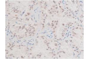 ABIN6267577 at 1/200 staining Human lung cancer tissue sections by IHC-P. (XIAP anticorps  (pSer87))