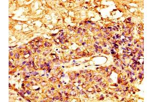 IHC image of ABIN7159428 diluted at 1:300 and staining in paraffin-embedded human ovarian cancer performed on a Leica BondTM system. (Mesothelin anticorps  (AA 37-598))