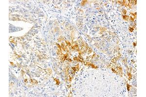 ABIN6259690 and ABIN6266757 at 1/100 staining Human liver cancer by IHC-P.