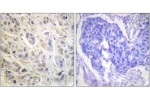 Immunohistochemistry analysis of paraffin-embedded human breast carcinoma tissue, using p90 RSK (Ab-573) Antibody. (RPS6KA3 anticorps  (AA 539-588))