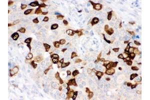 Anti- RRM2 Picoband antibody, IHC(P) IHC(P): Human Mammary Cancer Tissue