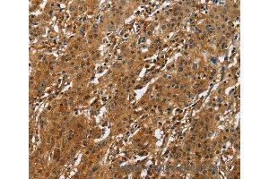 Immunohistochemistry of Human liver cancer using ATF4 Polyclonal Antibody at dilution of 1:50 (ATF4 anticorps)