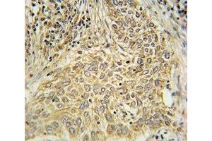 AHR antibody immunohistochemistry analysis in formalin fixed and paraffin embedded human lung carcinoma. (Aryl Hydrocarbon Receptor anticorps  (AA 555-582))