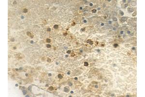 ABIN6259186 and ABIN6275604 at 1/100 staining human pituitary adenoma by IHC-P. (SF3B4 anticorps  (N-Term))