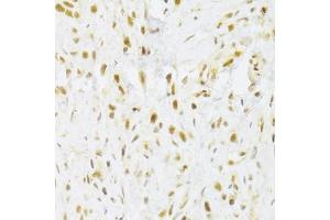 Immunohistochemistry of paraffin-embedded human gastric cancer using RBPJ Antibody (ABIN1876876) at dilution of 1:100 (40x lens). (RBPJ anticorps)