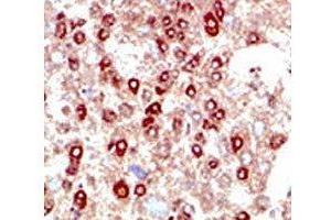 IHC testing of human hepatocarcinoma stained with SUMO2/3 antibody. (SUMO2/3 anticorps  (AA 49-81))